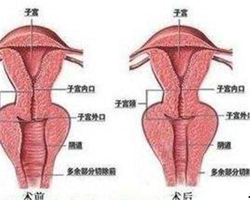 阴道松弛图片,揭秘女性私密健康问题