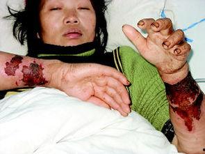 皮肤溃烂图片,病因、症状与治疗策略