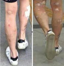 皮肤溃烂图片,病因、症状与治疗策略