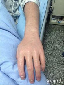 皮肤溃烂图片,病因、症状与治疗策略