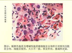 鳞状细胞癌图片,鳞状细胞癌病理特征与诊断要点解析