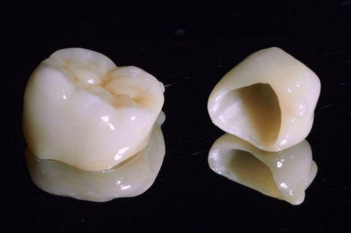 单颗牙套的图片,揭秘现代牙齿矫正的神奇之选