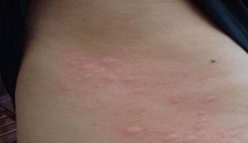 风片的症状图片